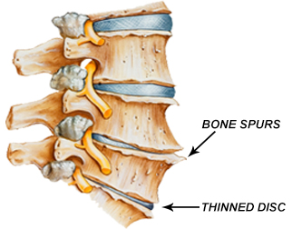 Arthritic Spine
